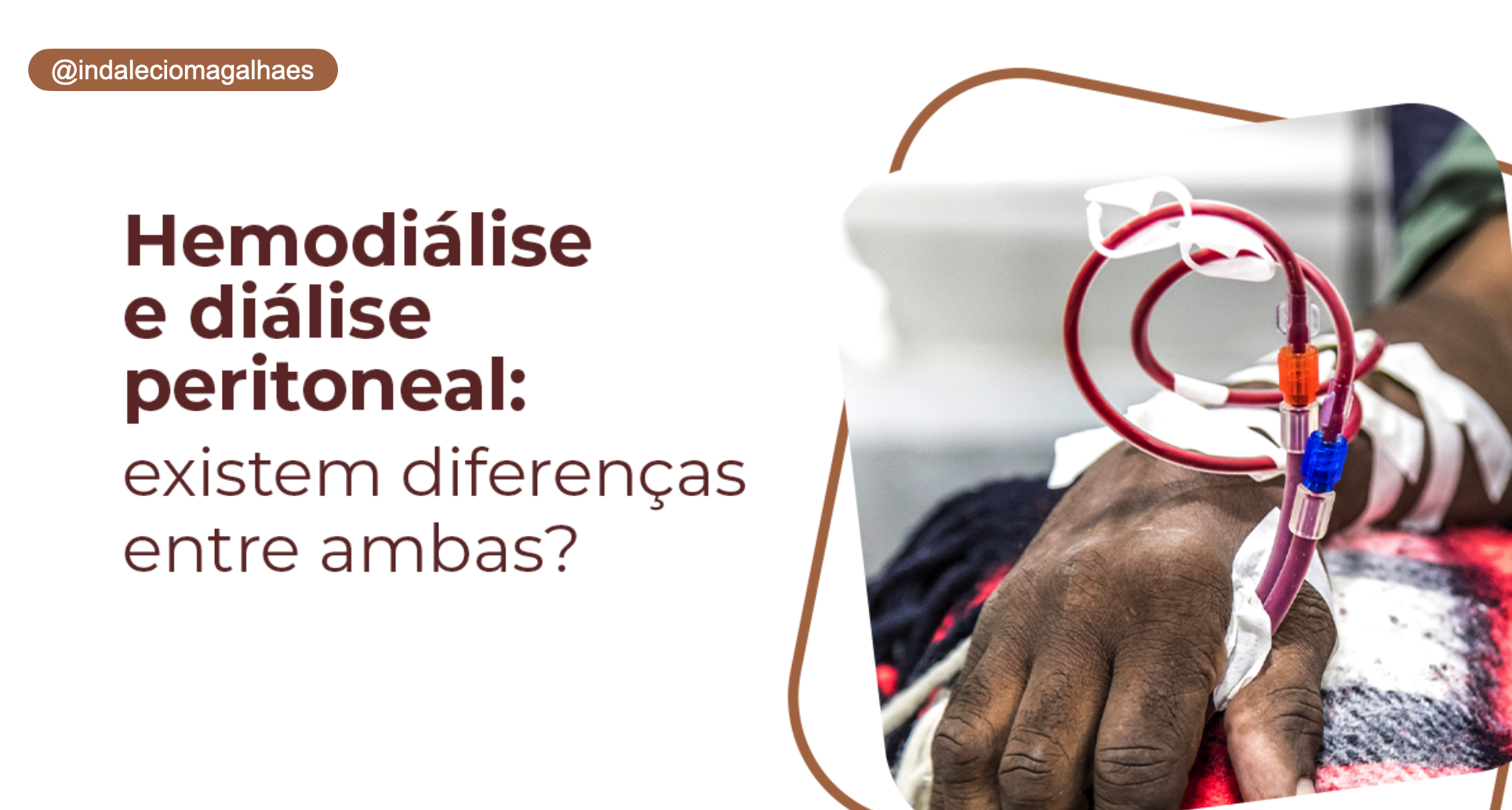 Hemodiálise ou Diálise Peritoneal: Qual a melhor opção para o meu caso?