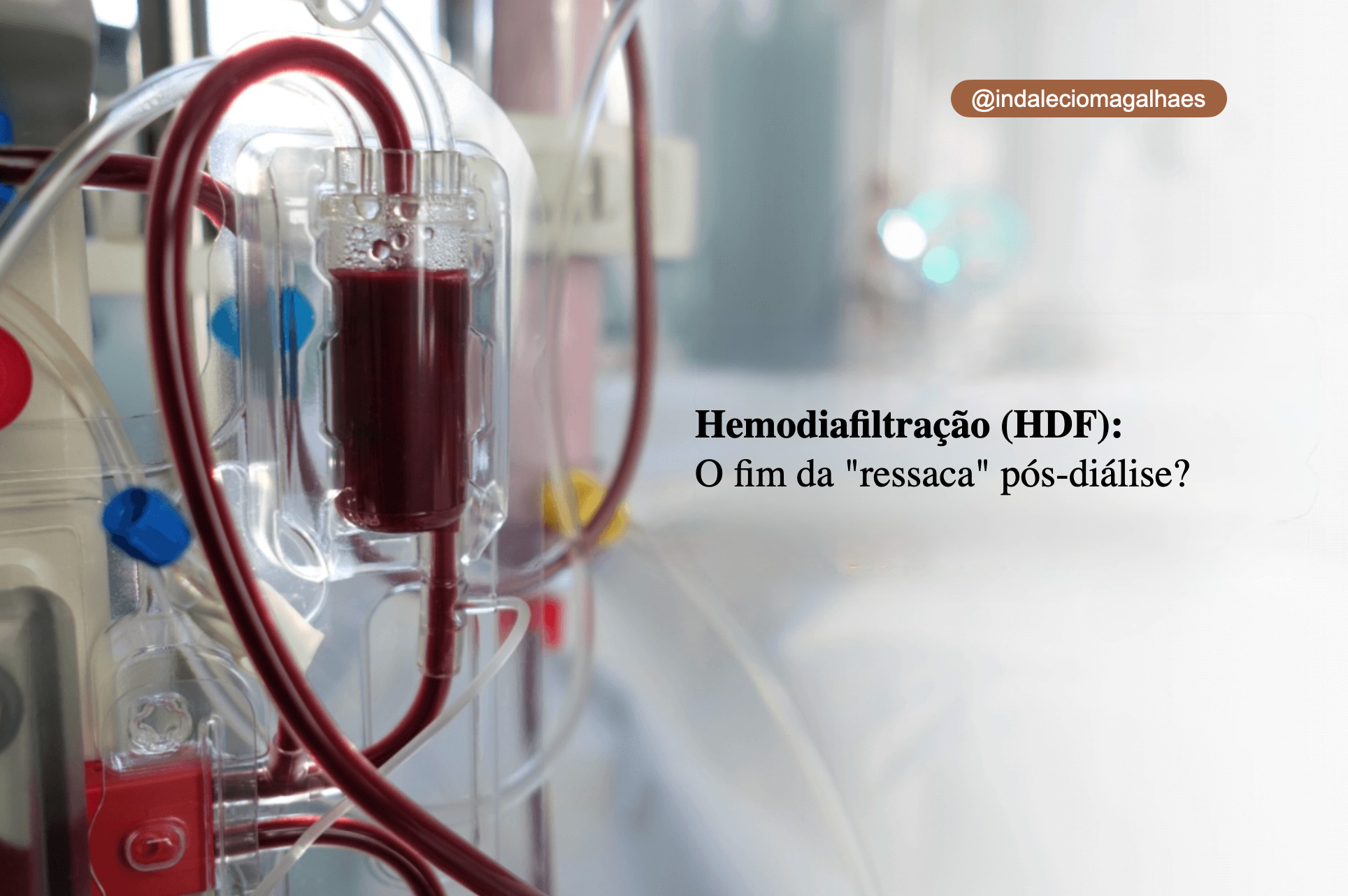 Hemodiafiltração (HDF): O fim da “ressaca” pós-diálise?